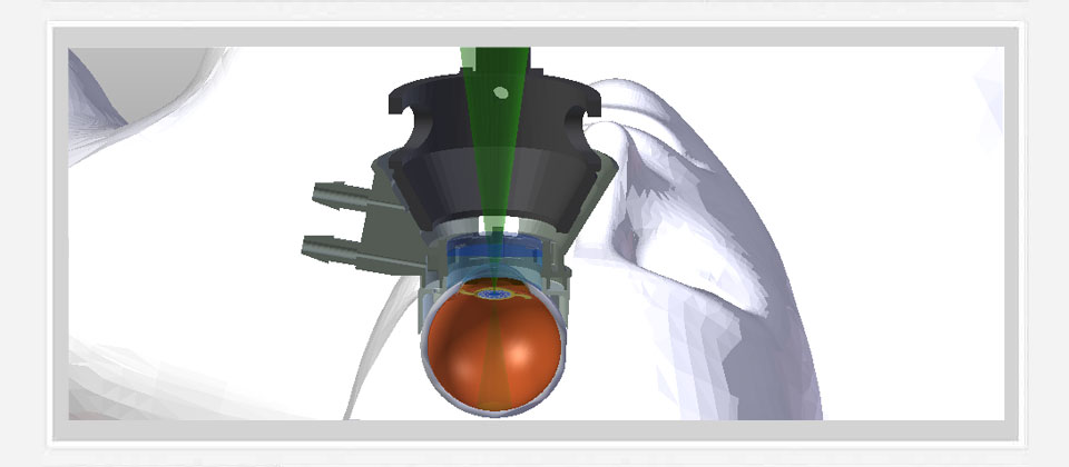 An animated image showing the theory of refractive index shaping. The image shows a the patient attachment docked to a patient and the green laser light treating the implatned intraocular lens. 